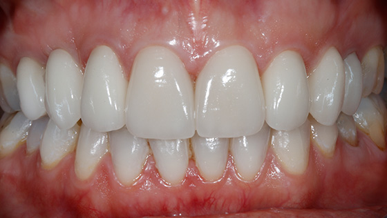 Implante unitario e injerto óseos y de encía simultáneos y estética dental. Odontología Interdisciplinar.