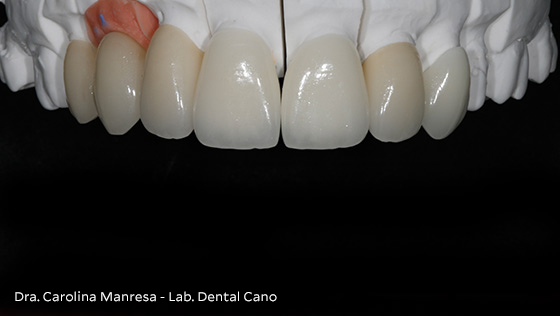 Implante unitario e injerto óseos y de encía simultáneos y estética dental. Odontología Interdisciplinar.