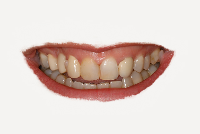 Ausencia prolongada de un diente (colmillo superior derecho)