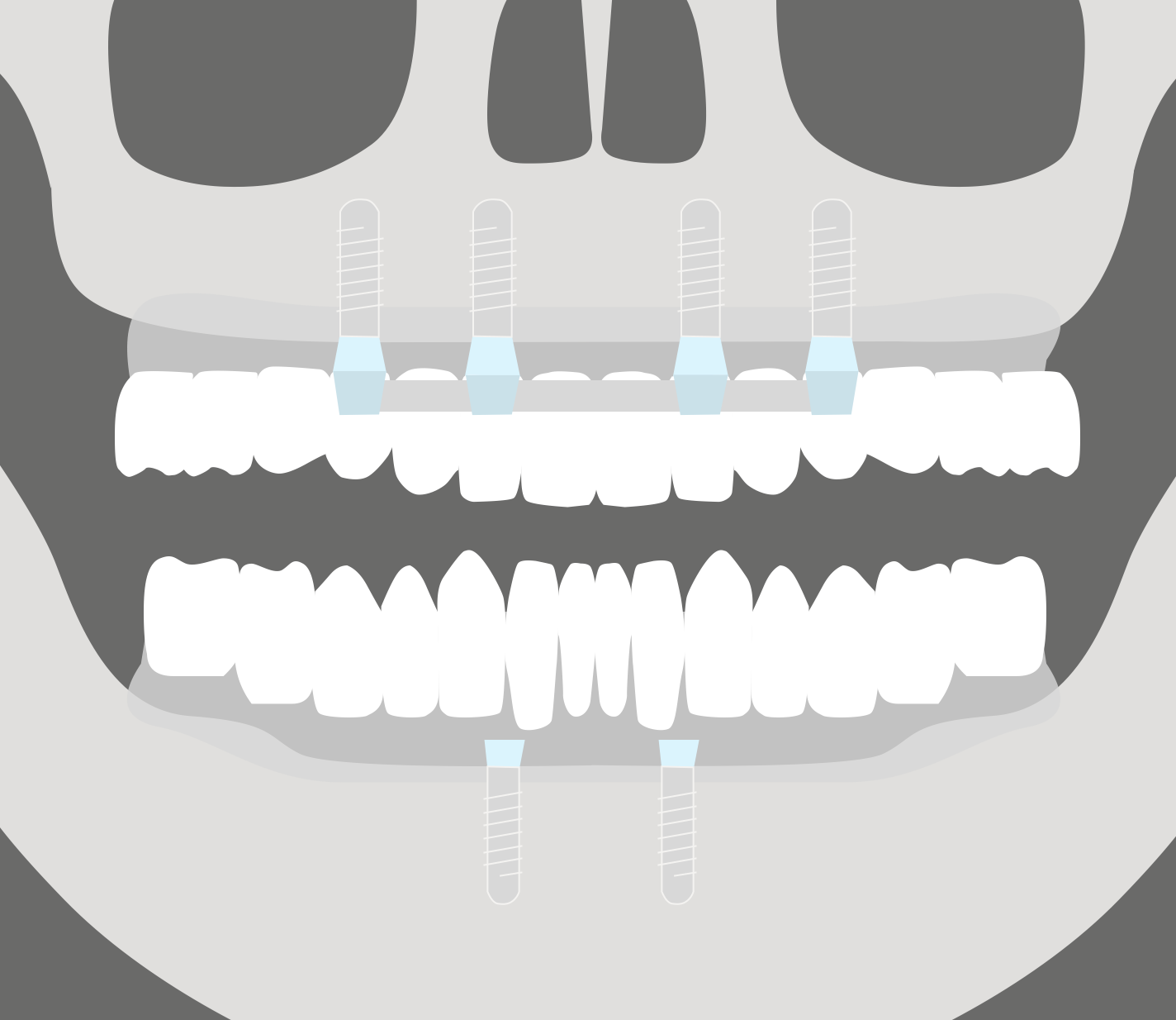 Fijación de la dentadura mediante implantes dentales. Sobredentaduras