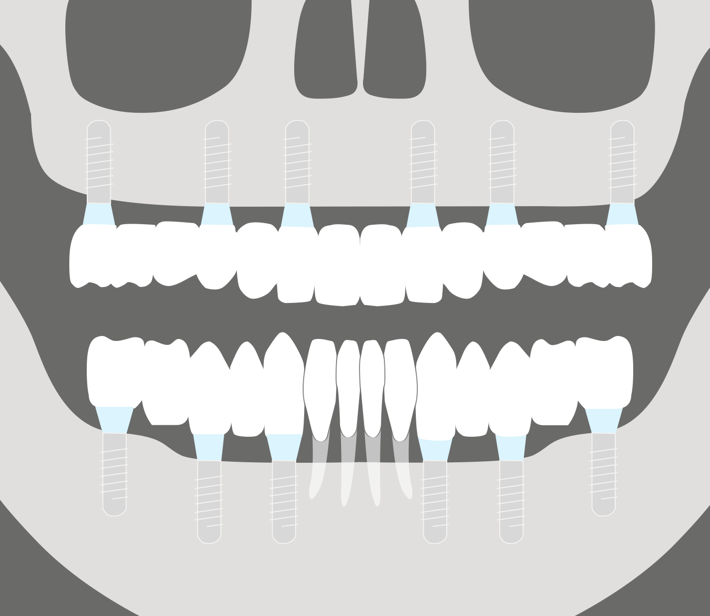 Reposición de varios dientes. Prótesis sobre implantes dentales tecnología CAD-CAM.