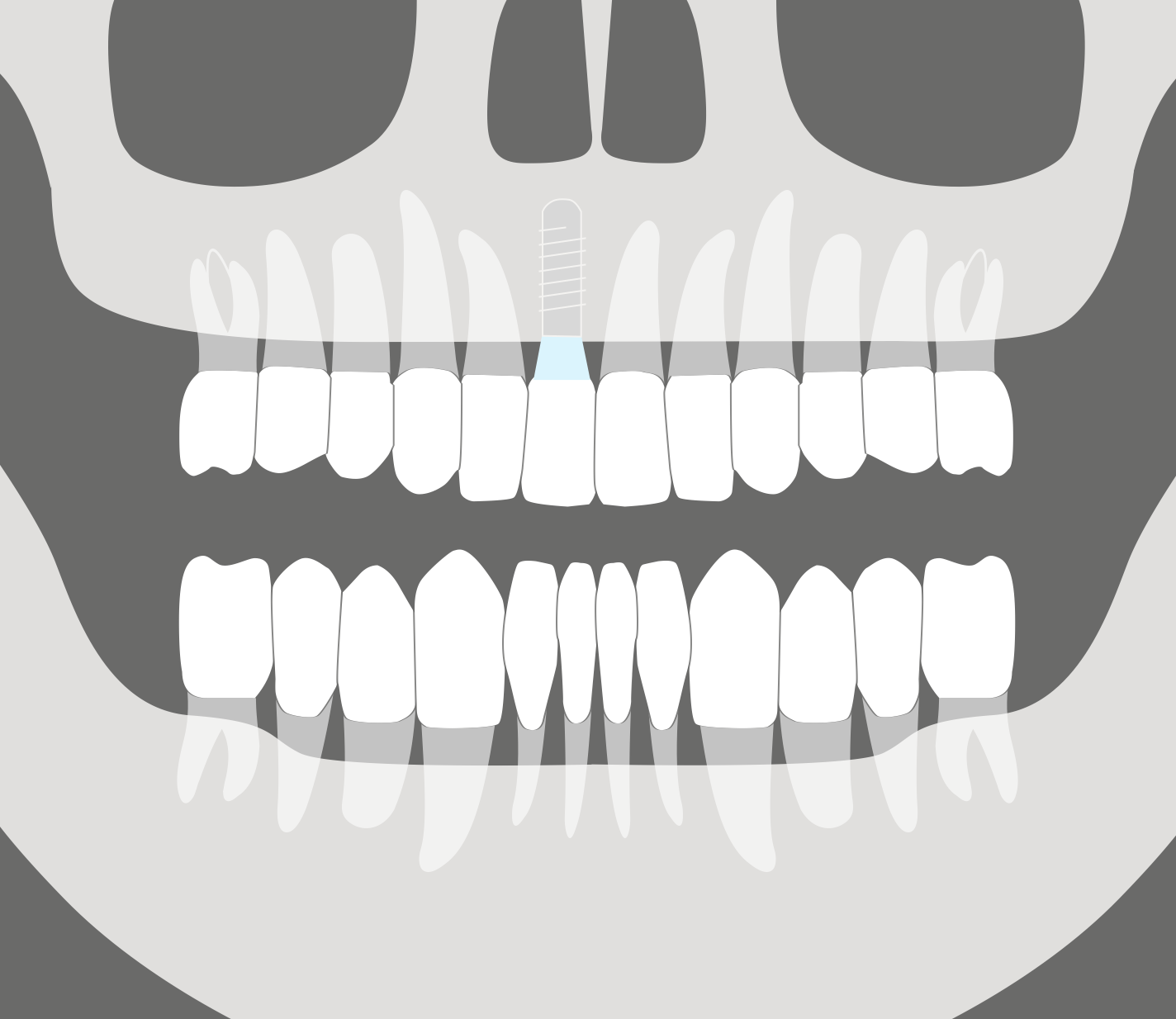 Reposición de un diente anterior.