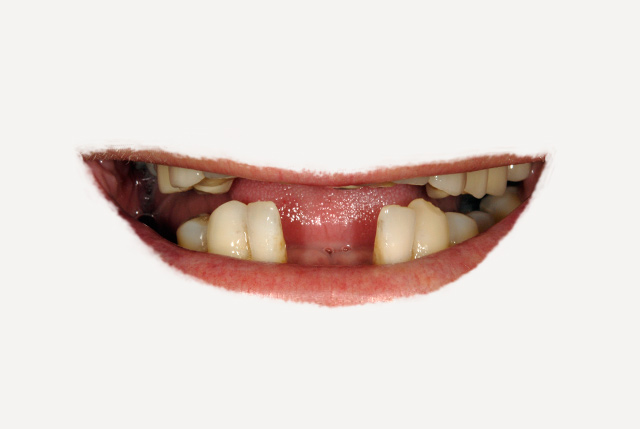 Ausencia de varios dientes y sonrisa invertida. Edentulismo parcial.