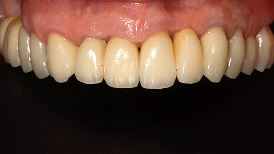 Secuelas de la enfermedad periodontal