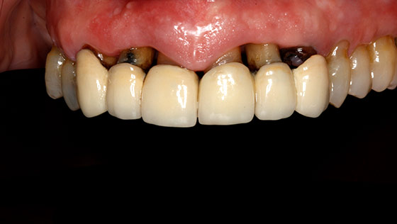 Secuelas de la enfermedad periodontal